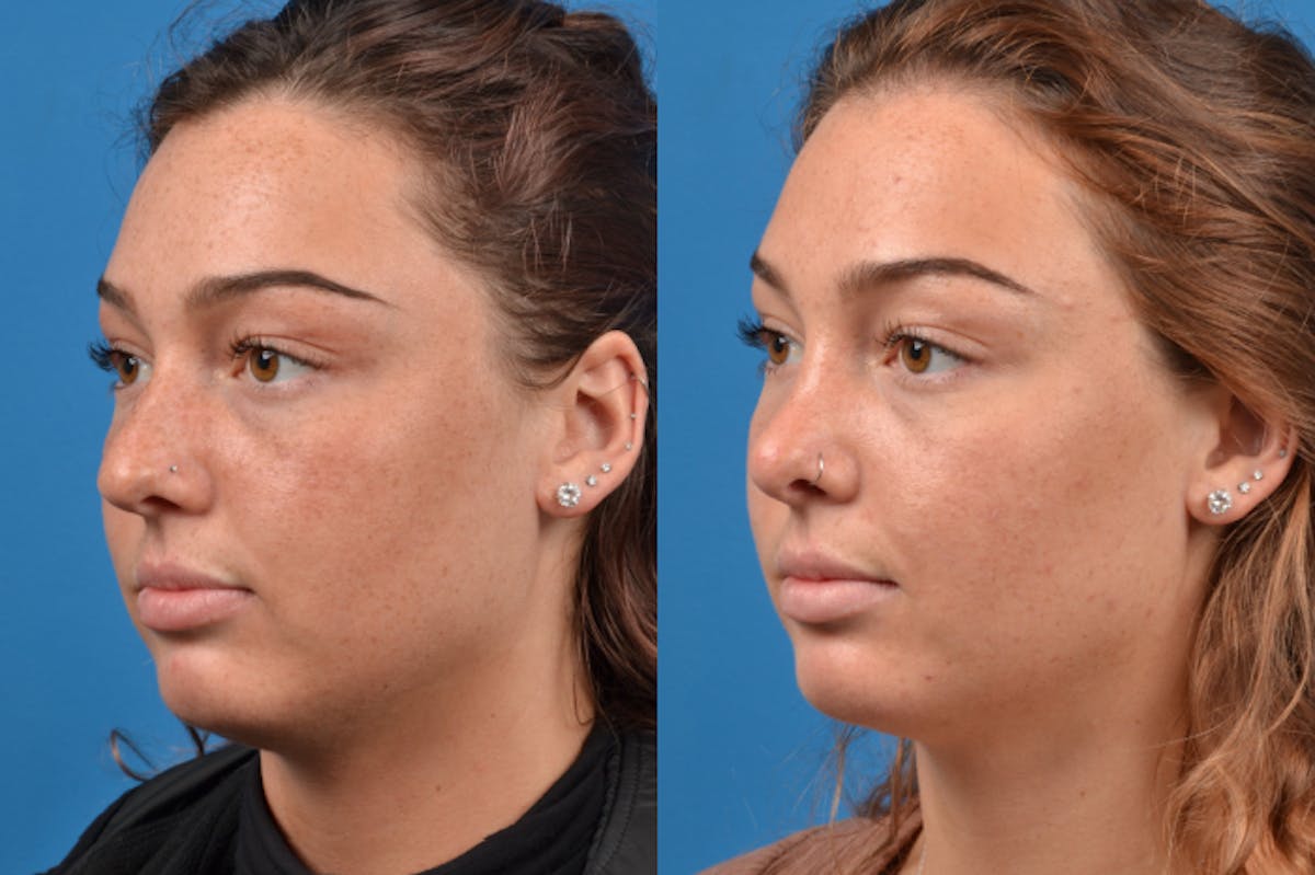 Rhinoplasty Before & After Gallery - Patient 122406945 - Image 5