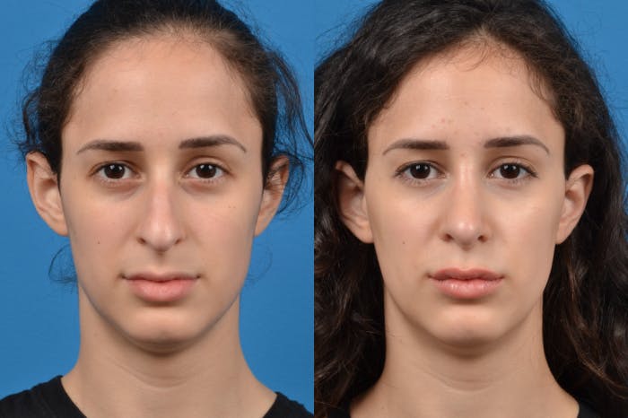 Rhinoplasty Before & After Gallery - Patient 122406946 - Image 1