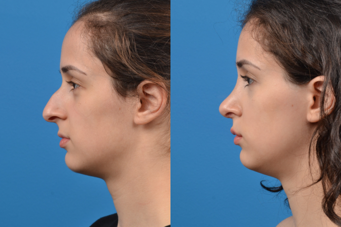Rhinoplasty Before & After Gallery - Patient 122406946 - Image 2