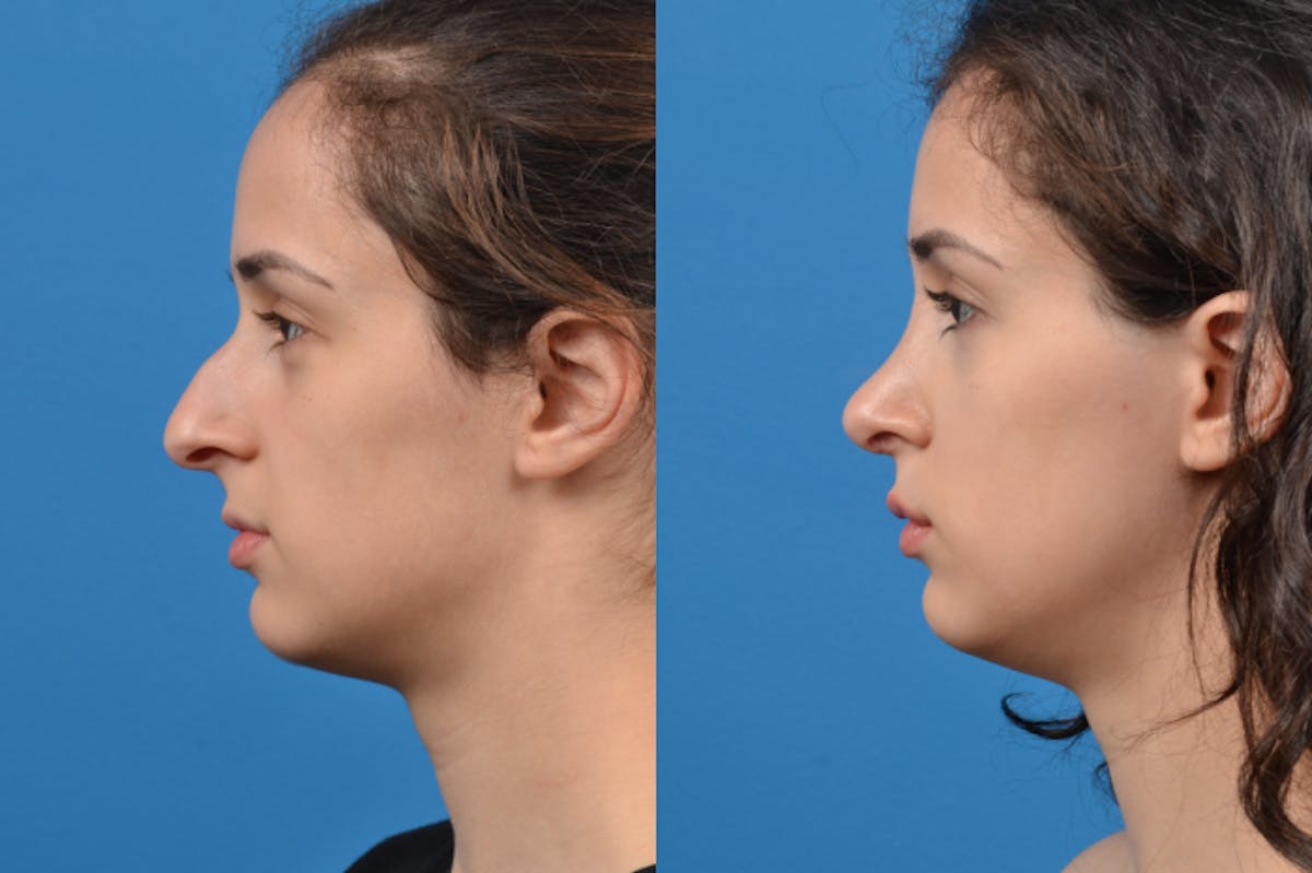 Rhinoplasty Before & After Gallery - Patient 122406946 - Image 2