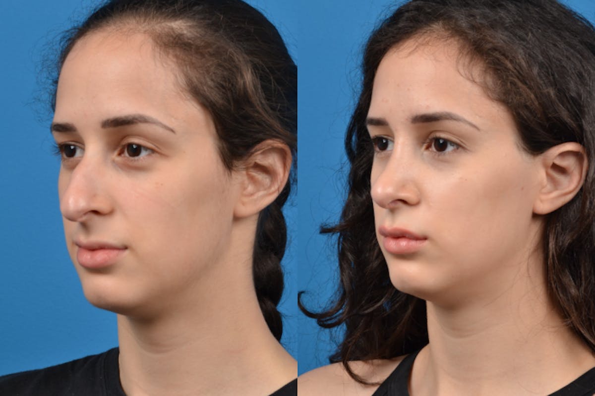 Rhinoplasty Before & After Gallery - Patient 122406946 - Image 3