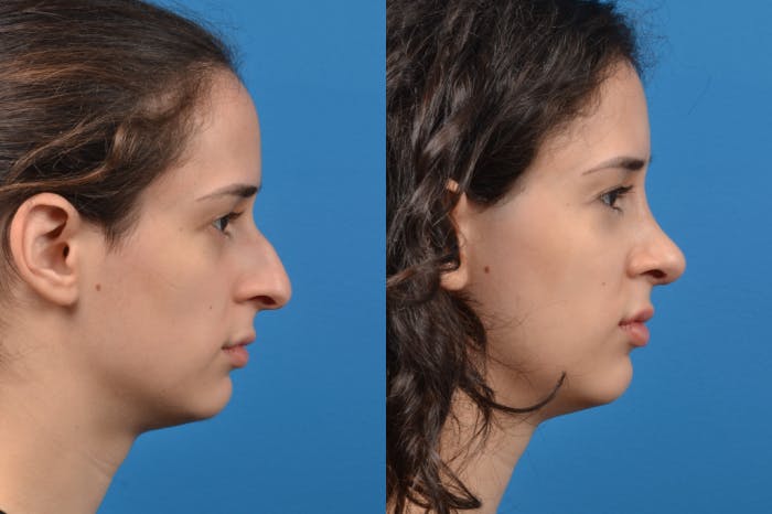 Rhinoplasty Before & After Gallery - Patient 122406946 - Image 4