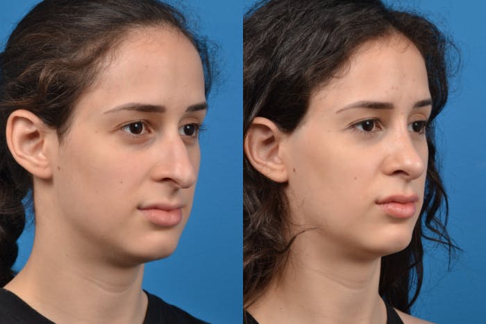 Rhinoplasty Before & After Gallery - Patient 122406946 - Image 5