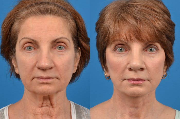 Rhinoplasty Before & After Gallery - Patient 122406947 - Image 1