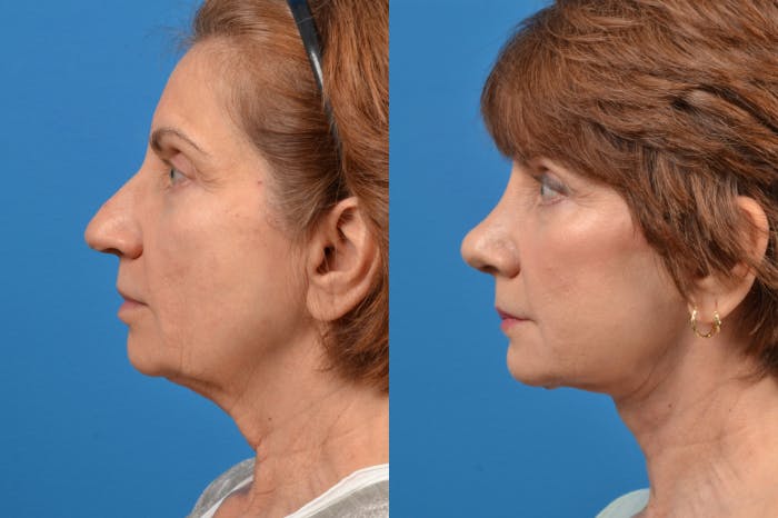 Rhinoplasty Before & After Gallery - Patient 122406947 - Image 2
