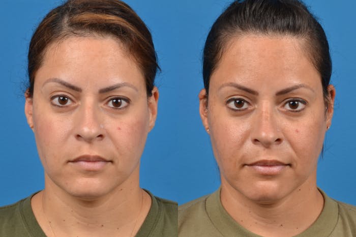 Rhinoplasty Before & After Gallery - Patient 122406951 - Image 1