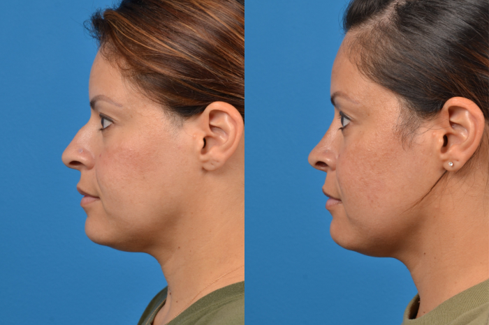 Rhinoplasty Before & After Gallery - Patient 122406951 - Image 2