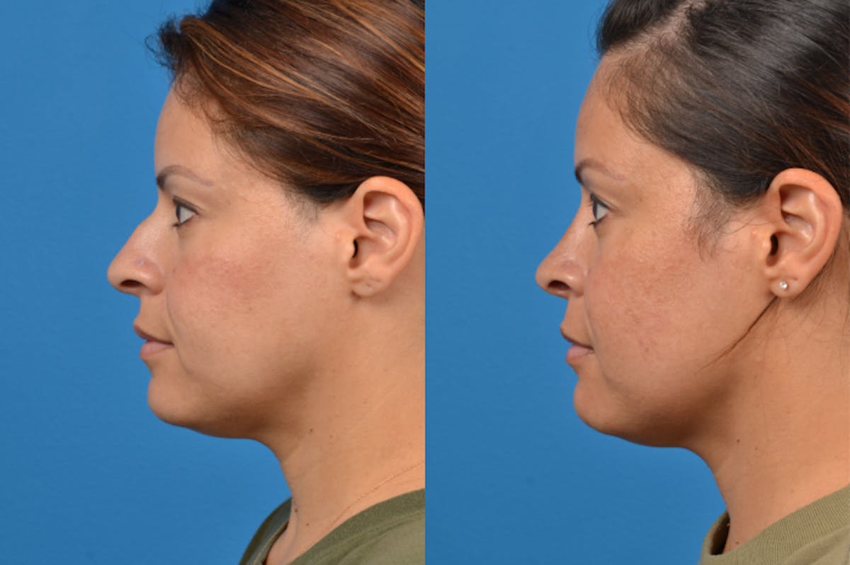 Rhinoplasty Before & After Gallery - Patient 122406951 - Image 2