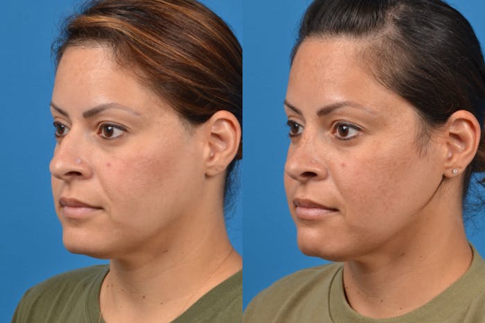 Rhinoplasty Before & After Gallery - Patient 122406951 - Image 3