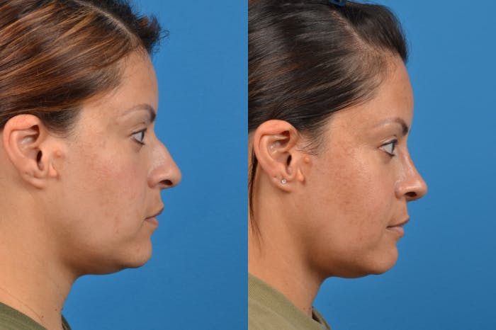 Rhinoplasty Before & After Gallery - Patient 122406951 - Image 4