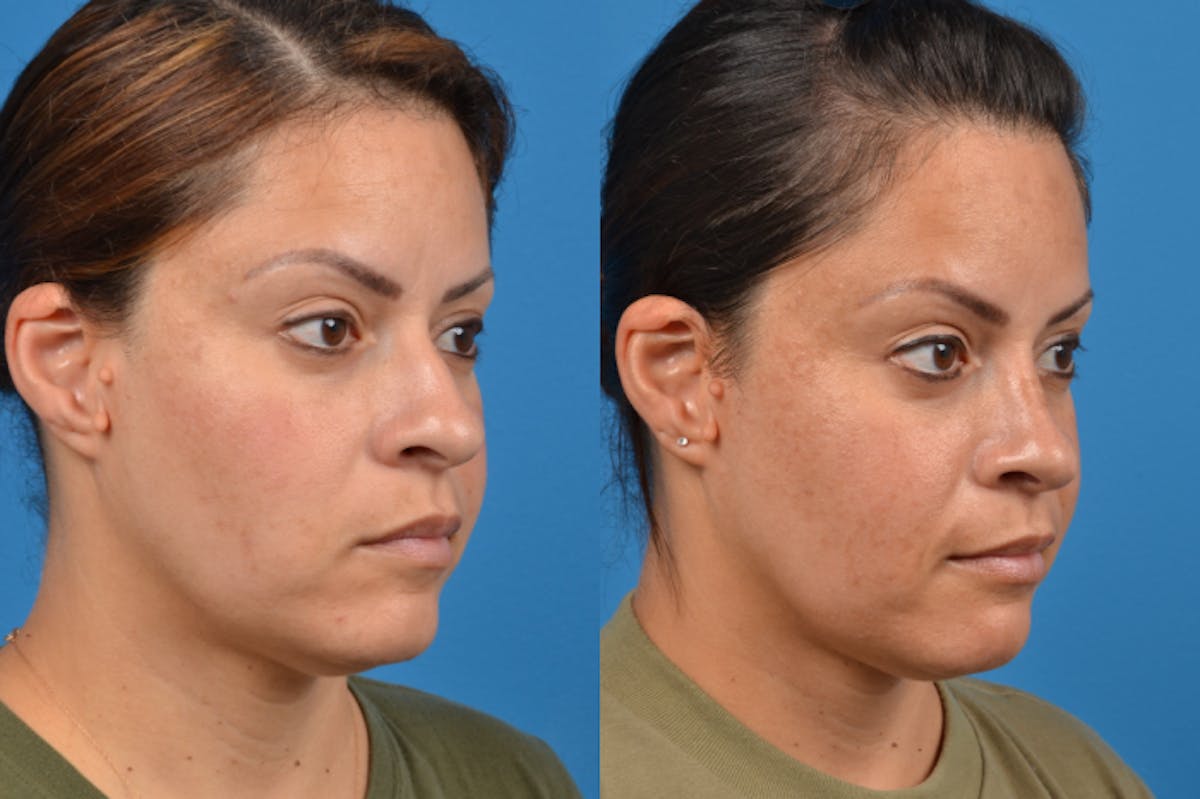 Rhinoplasty Before & After Gallery - Patient 122406951 - Image 5