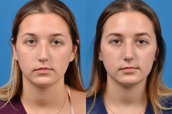 Rhinoplasty Before & After Gallery - Patient 122406952 - Image 1