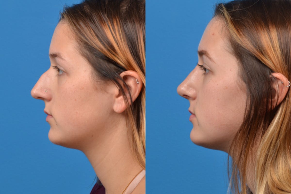 Rhinoplasty Before & After Gallery - Patient 122406952 - Image 2