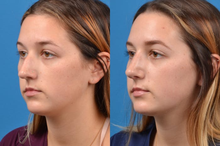 Rhinoplasty Before & After Gallery - Patient 122406952 - Image 3