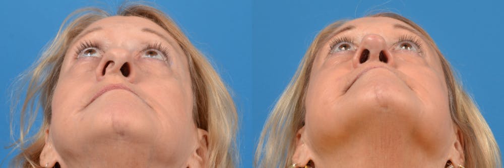 Rhinoplasty Before & After Gallery - Patient 122406955 - Image 1
