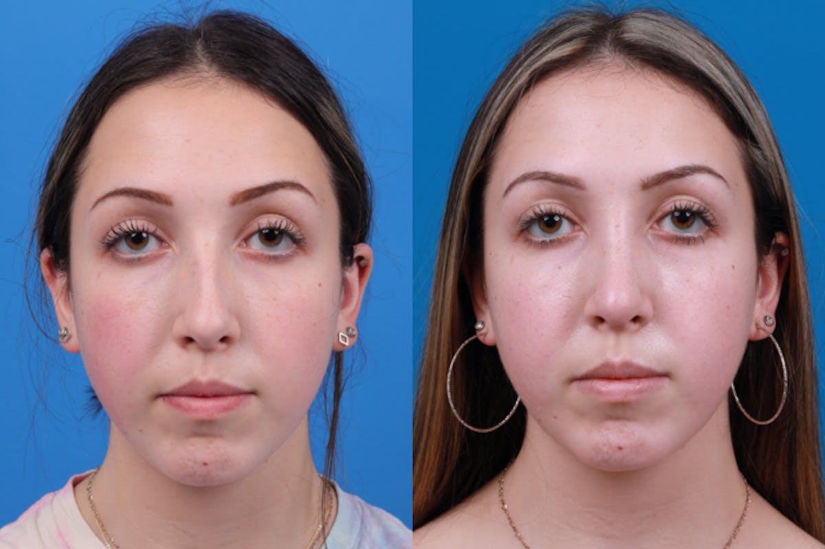 Rhinoplasty Before & After Gallery - Patient 122406957 - Image 1