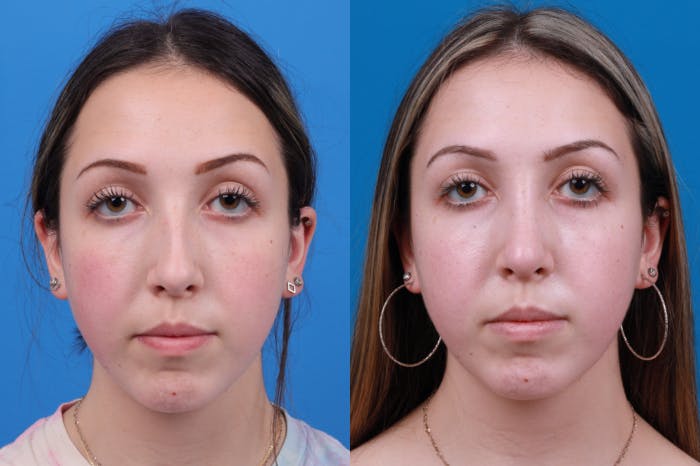 Rhinoplasty Before & After Gallery - Patient 122406957 - Image 1