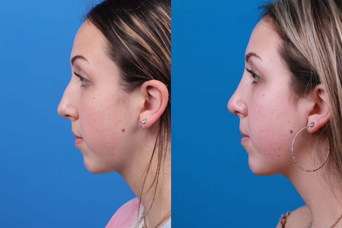 Rhinoplasty Before & After Gallery - Patient 122406957 - Image 2