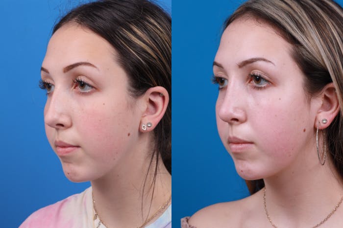 Rhinoplasty Before & After Gallery - Patient 122406957 - Image 3