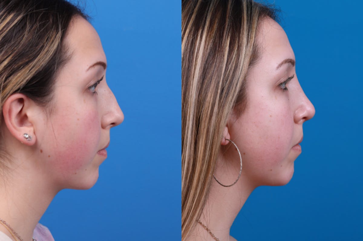 Rhinoplasty Before & After Gallery - Patient 122406957 - Image 4