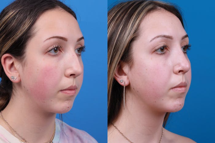 Rhinoplasty Before & After Gallery - Patient 122406957 - Image 5