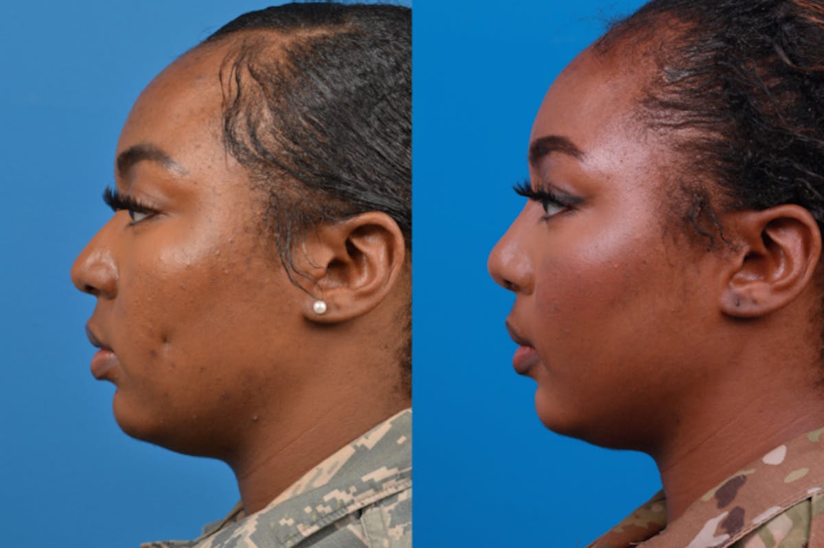 Rhinoplasty Before & After Gallery - Patient 122406958 - Image 2