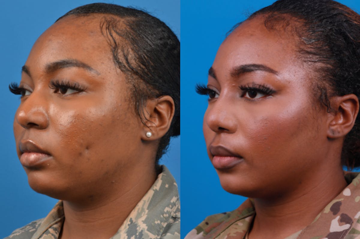 Rhinoplasty Before & After Gallery - Patient 122406958 - Image 3