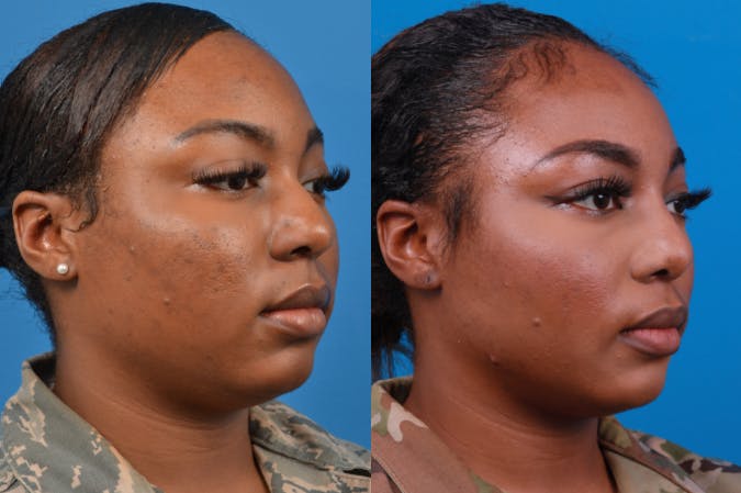 Rhinoplasty Before & After Gallery - Patient 122406958 - Image 5