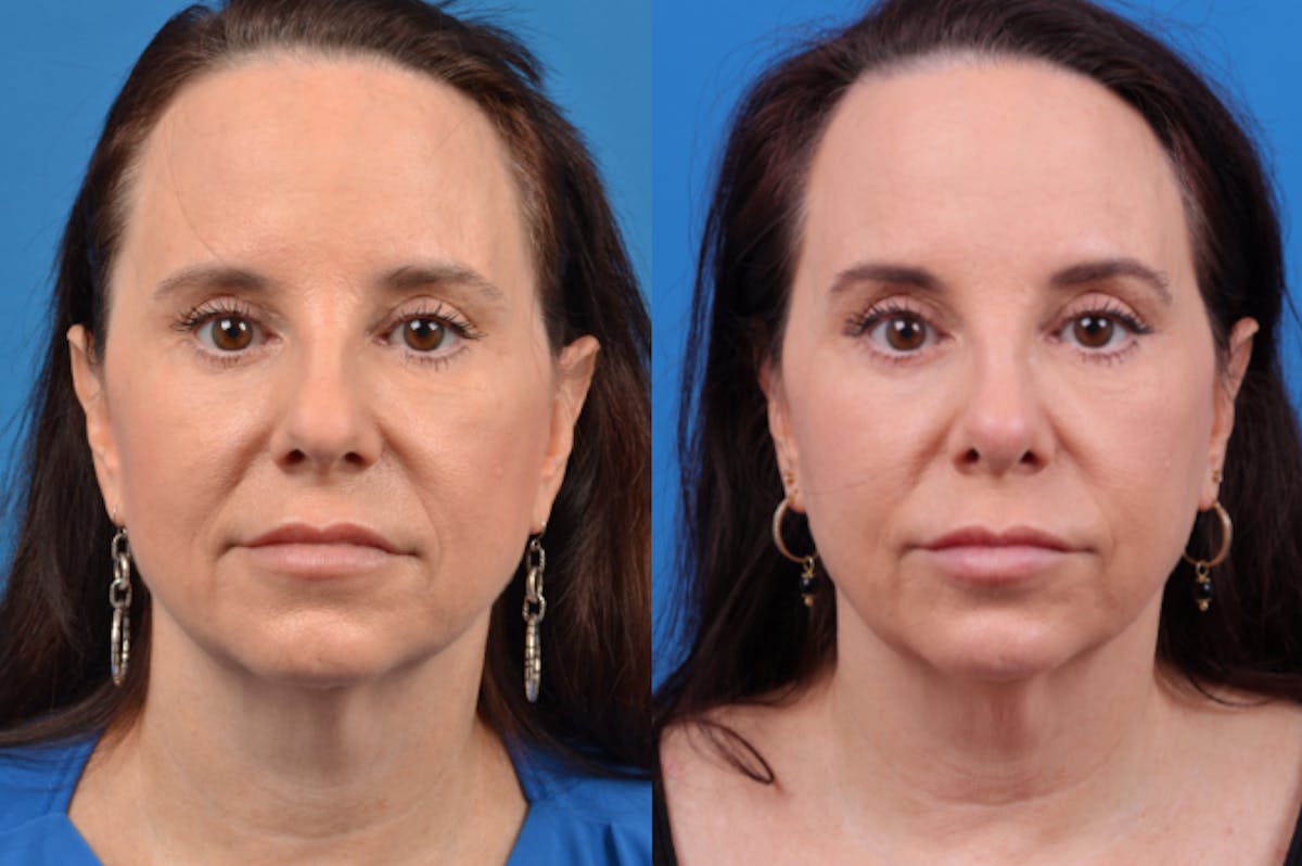 Rhinoplasty Before & After Gallery - Patient 122406959 - Image 1