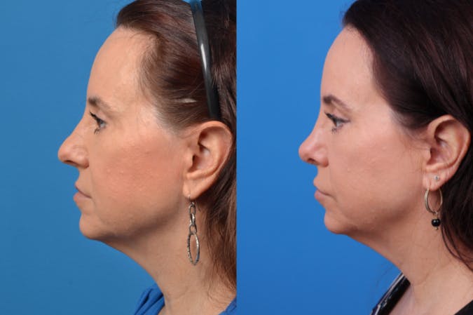 Rhinoplasty Before & After Gallery - Patient 122406959 - Image 2