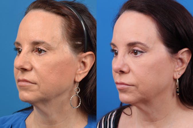 Rhinoplasty Before & After Gallery - Patient 122406959 - Image 3