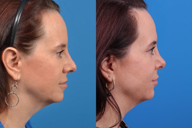Rhinoplasty Before & After Gallery - Patient 122406959 - Image 4