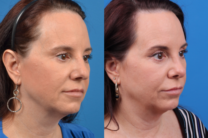 Rhinoplasty Before & After Gallery - Patient 122406959 - Image 5