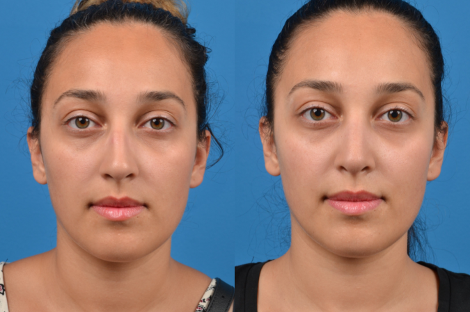 Rhinoplasty Before & After Gallery - Patient 122406960 - Image 1