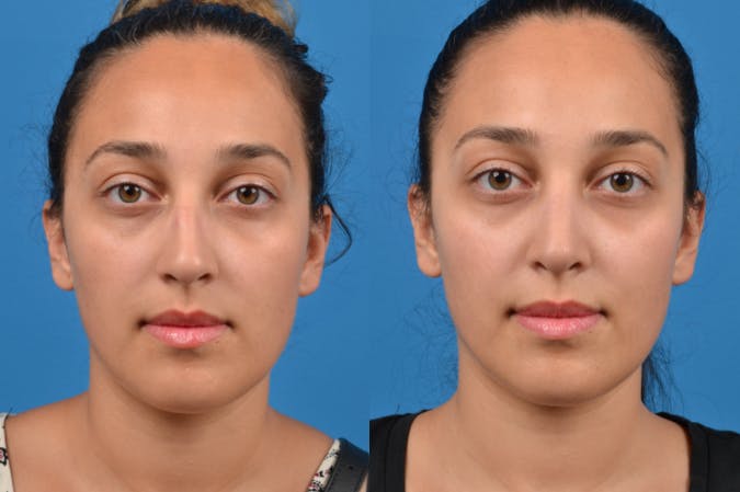 Rhinoplasty Before & After Gallery - Patient 122406960 - Image 1