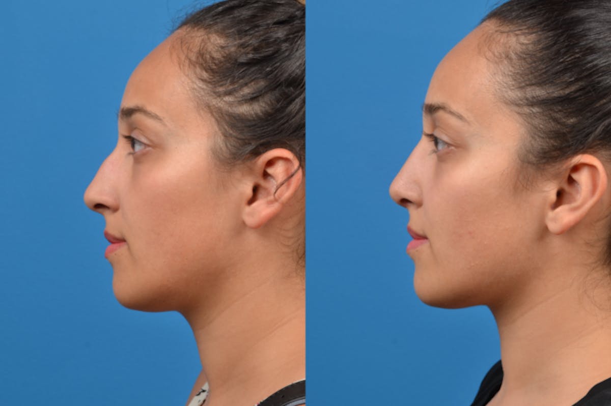 Rhinoplasty Before & After Gallery - Patient 122406960 - Image 2