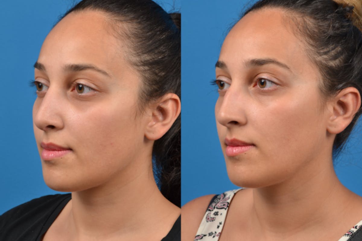 Rhinoplasty Before & After Gallery - Patient 122406960 - Image 3
