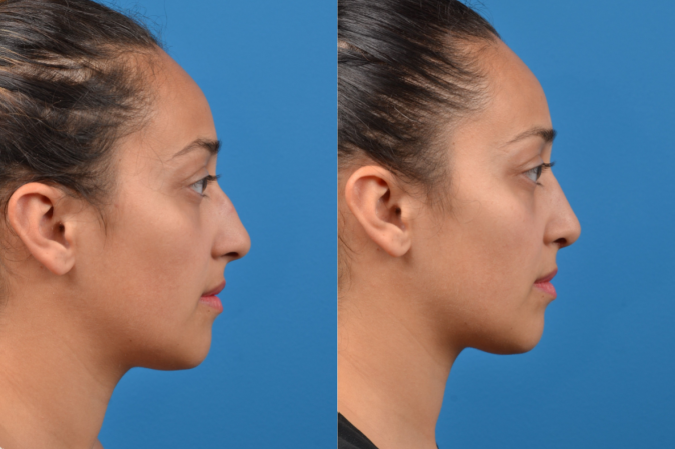 Rhinoplasty Before & After Gallery - Patient 122406960 - Image 4