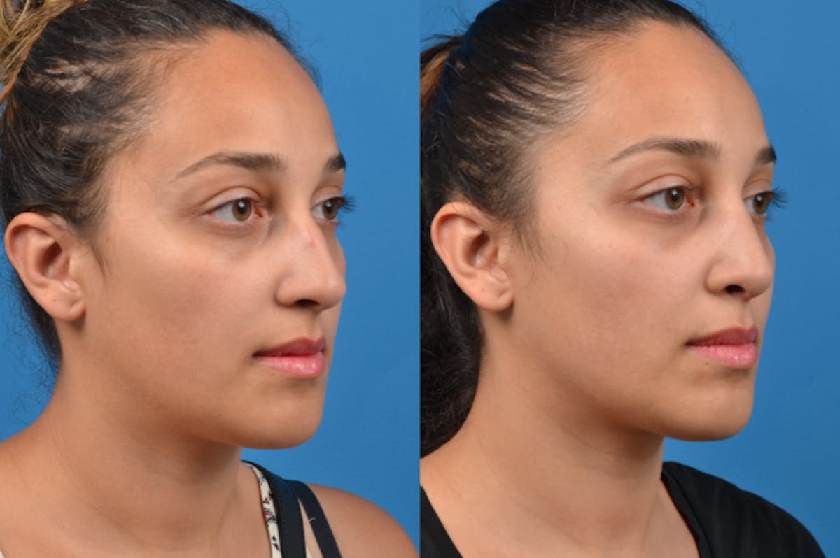 Rhinoplasty Before & After Gallery - Patient 122406960 - Image 5
