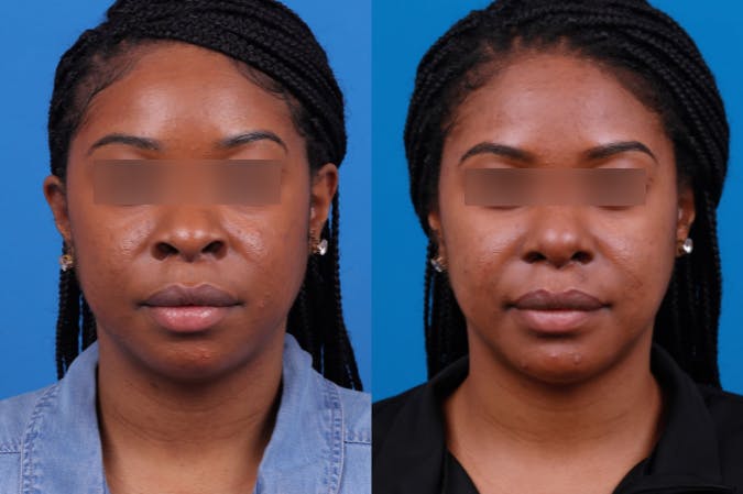 Rhinoplasty Before & After Gallery - Patient 122406961 - Image 1
