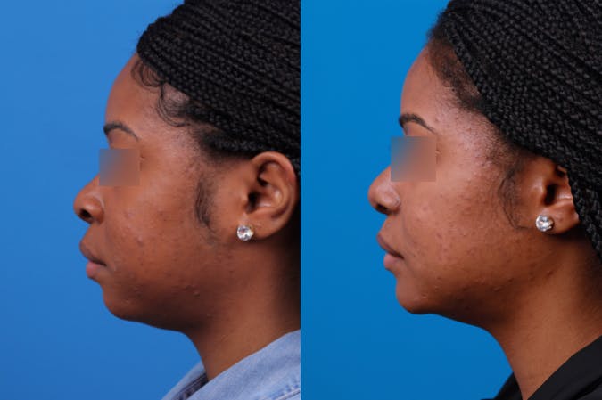 Rhinoplasty Before & After Gallery - Patient 122406961 - Image 2