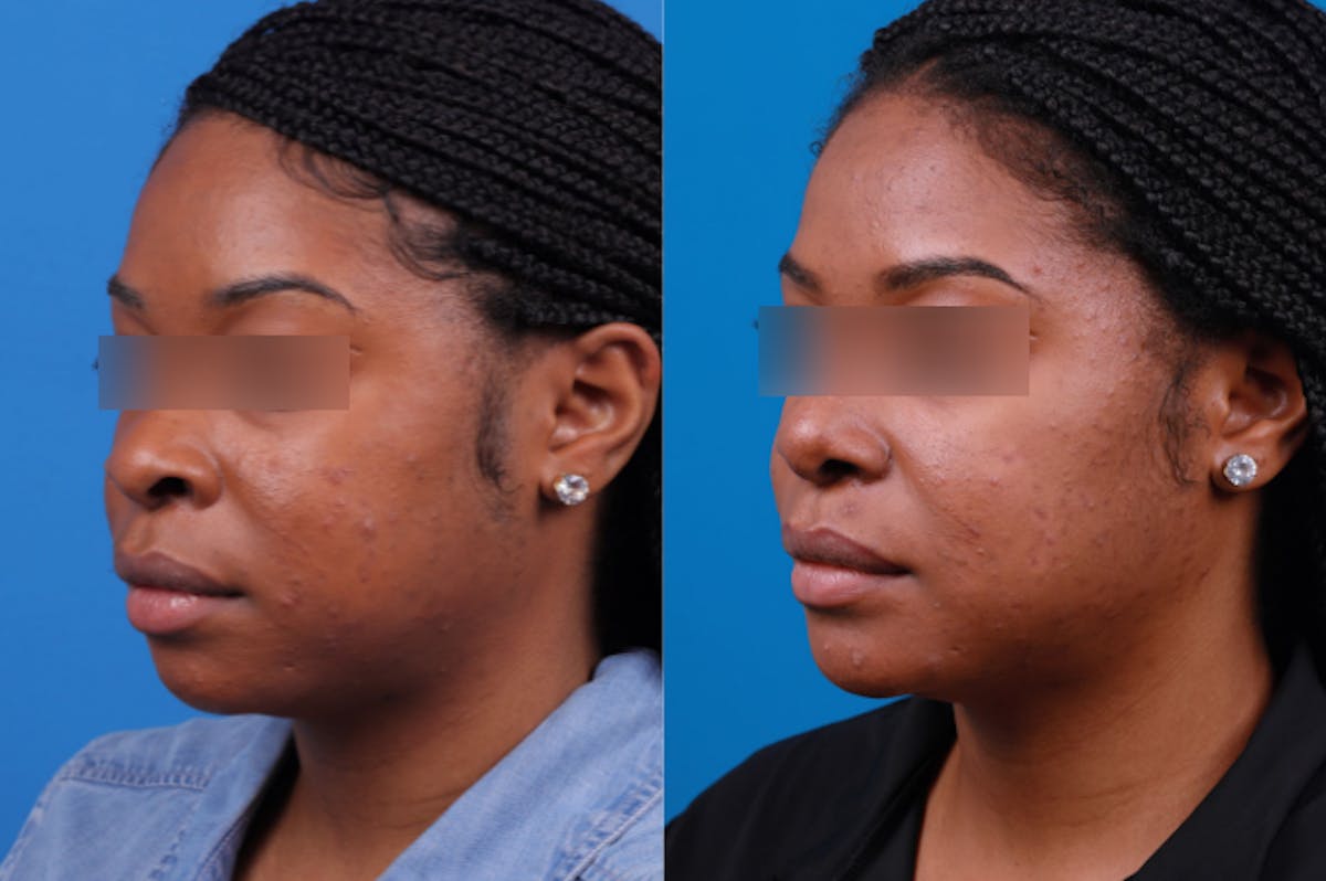 Rhinoplasty Before & After Gallery - Patient 122406961 - Image 3