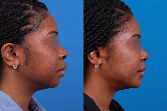 Rhinoplasty Before & After Gallery - Patient 122406961 - Image 4