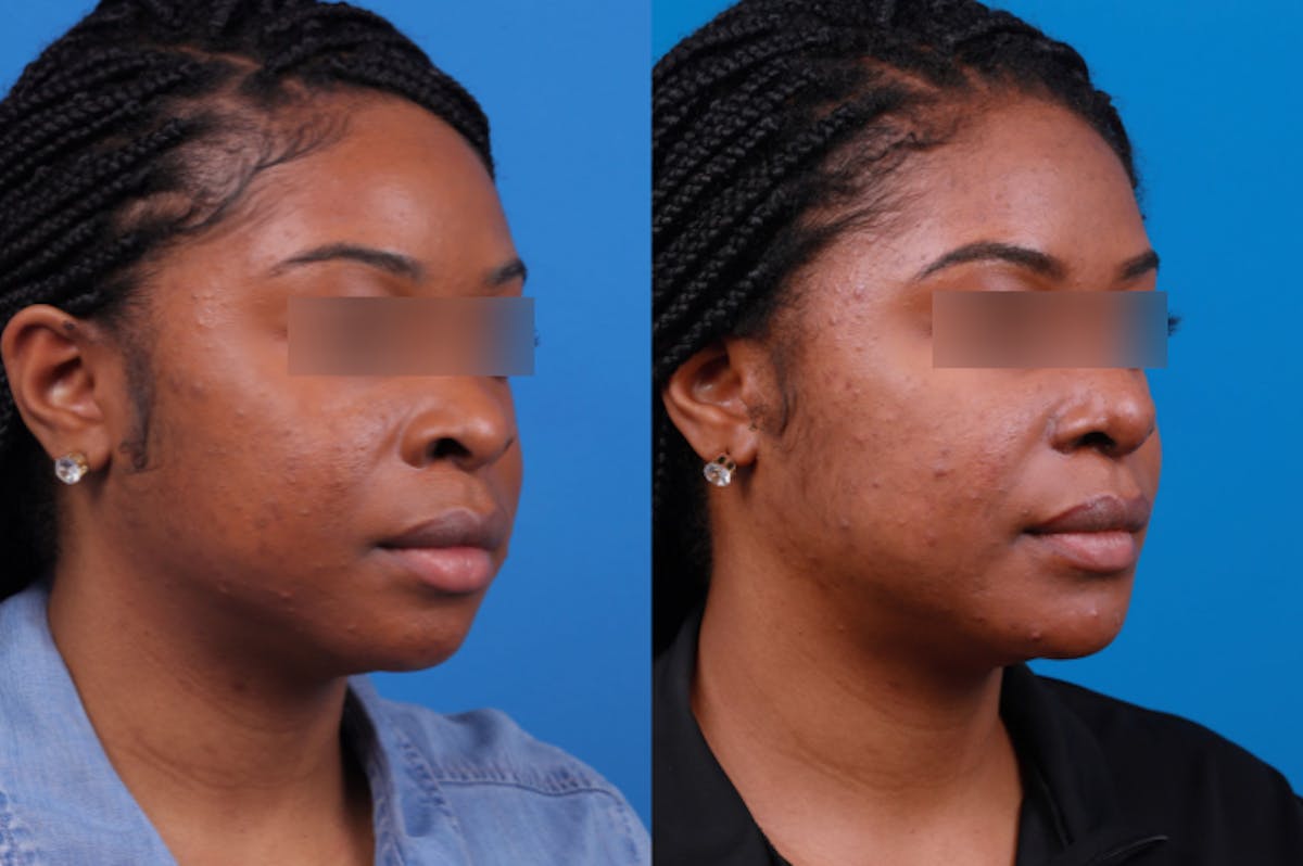 Rhinoplasty Before & After Gallery - Patient 122406961 - Image 5