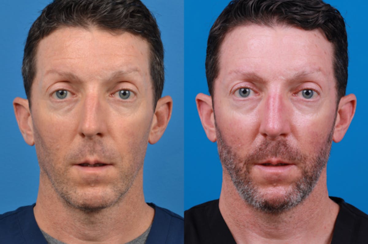 Rhinoplasty Before & After Gallery - Patient 122406964 - Image 1