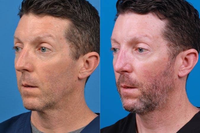 Rhinoplasty Before & After Gallery - Patient 122406964 - Image 3