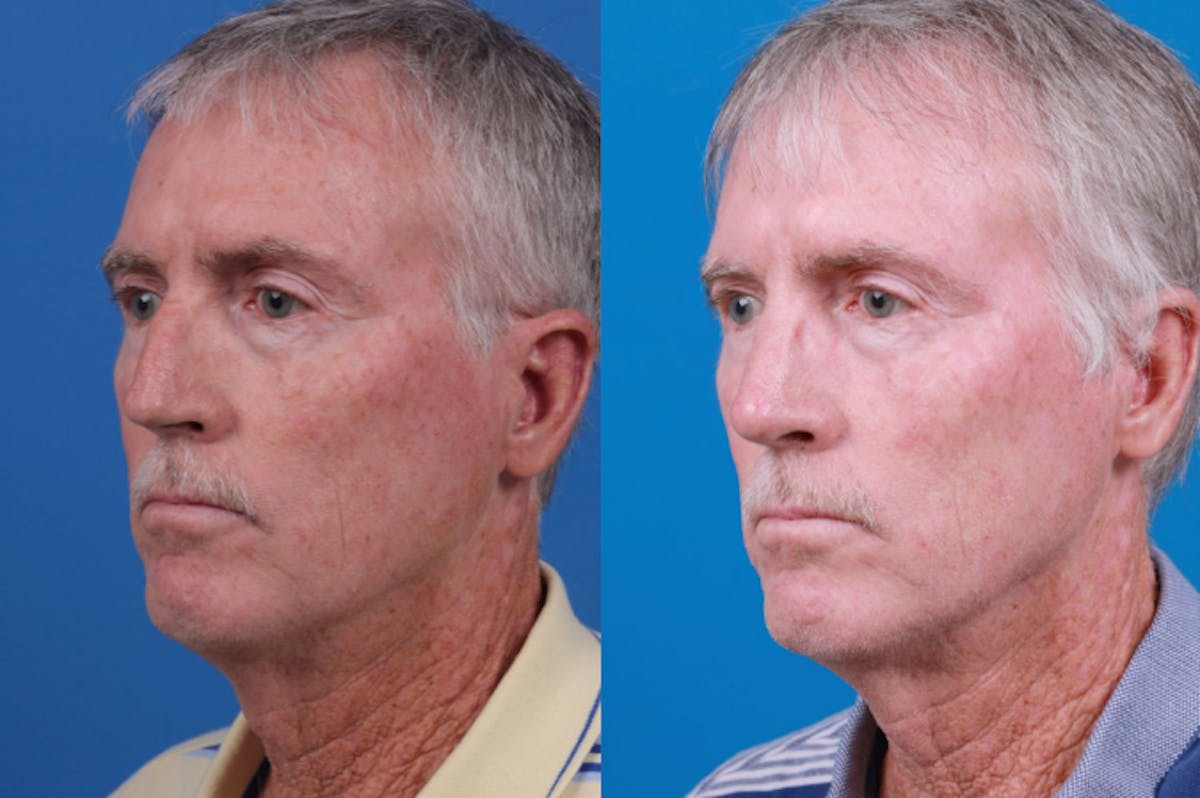Rhinoplasty Before & After Gallery - Patient 122406965 - Image 3