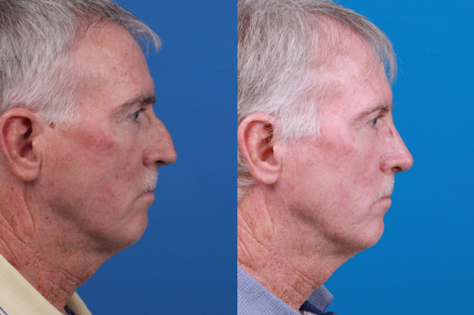 Rhinoplasty Before & After Gallery - Patient 122406965 - Image 4