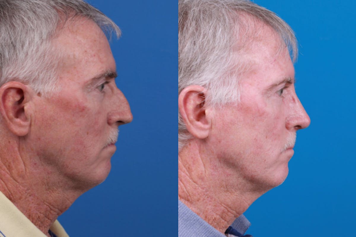 Rhinoplasty Before & After Gallery - Patient 122406965 - Image 4