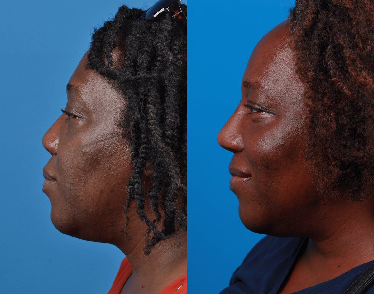 Rhinoplasty Before & After Gallery - Patient 122406972 - Image 1